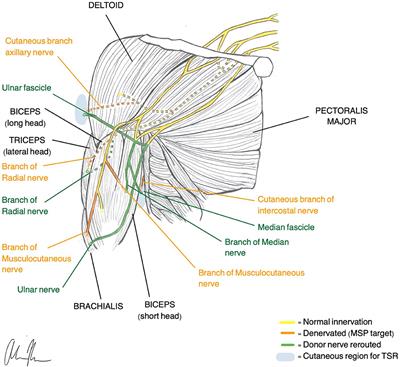 The Need to Work Arm in Arm: Calling for Collaboration in Delivering Neuroprosthetic Limb Replacements